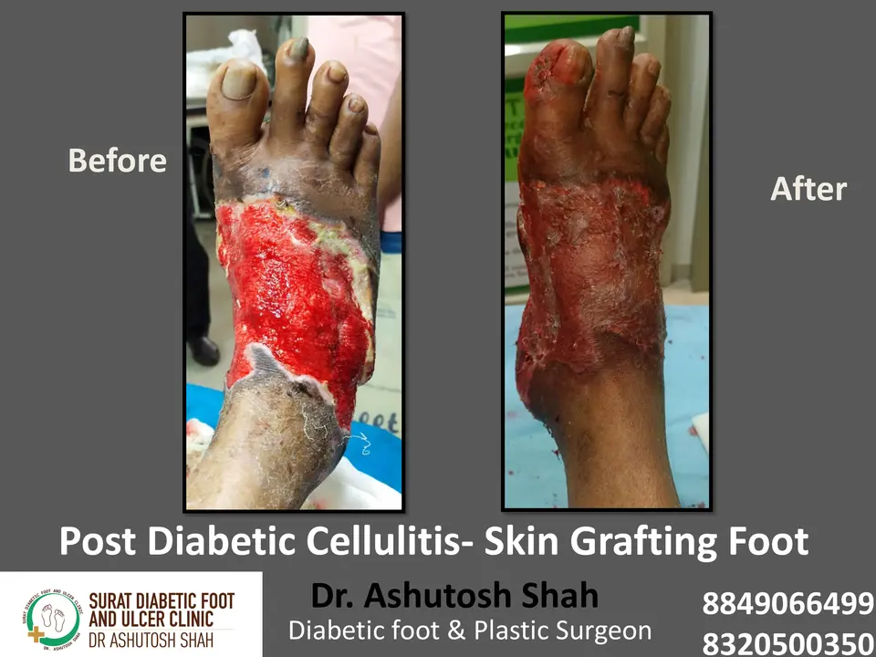 Diabetic Foot  PPT 3 checked by sir.pptx-31.webp